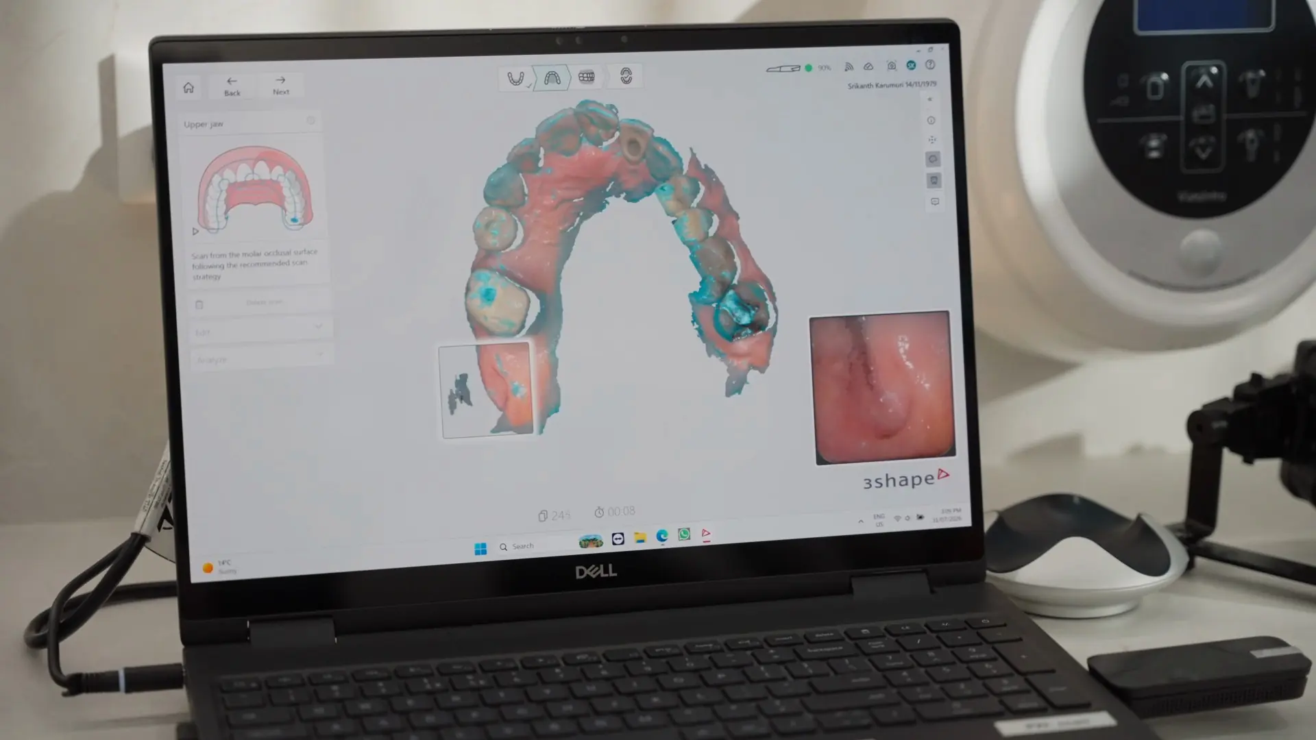 Scanning software showing a digital model of the teeth