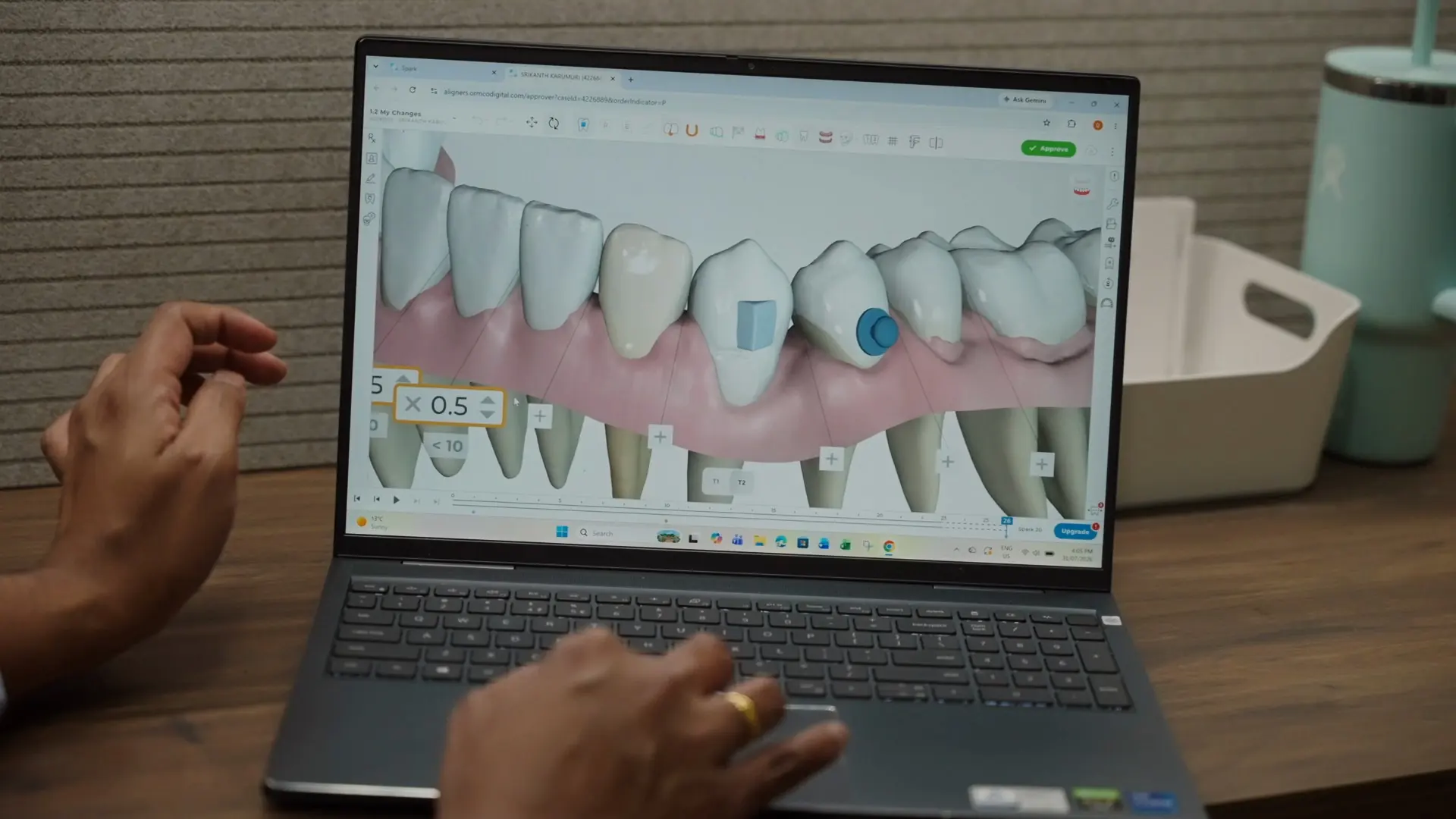 Implant planning software showing a digital model of the teeth