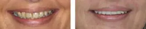 before-after-1