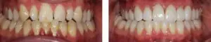 before-after-2