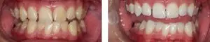 before-after-3