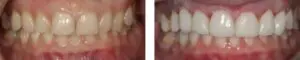 before-after-4