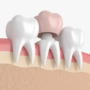 crowns-img-ser