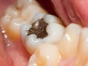 discolored-fillings-img