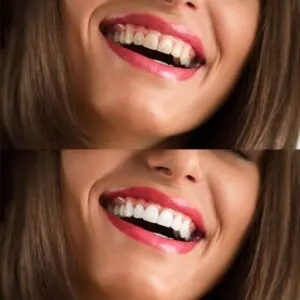 discolored-teeth-img-pg