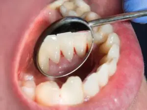 gingivitis-img