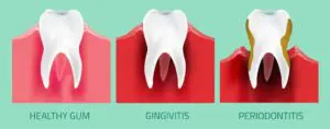 gum-disease-graphic-min-img