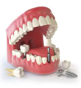 implants-img