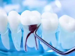 Root canal