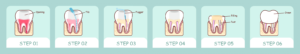 rct-treatment-step