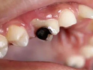 tooth-decay-img