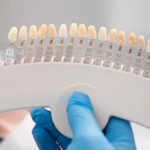 veneers-counter-2