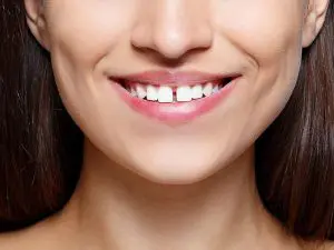 gappyteeth