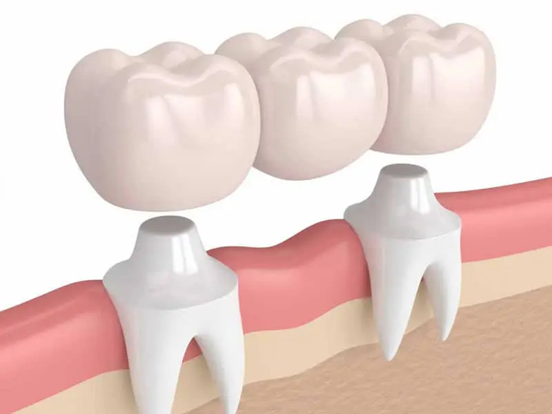 Dental bridge